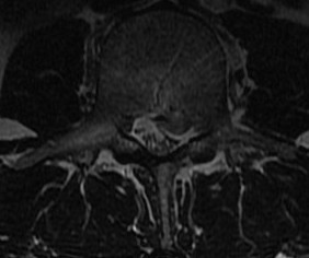 Sequestered Disc MRI 3